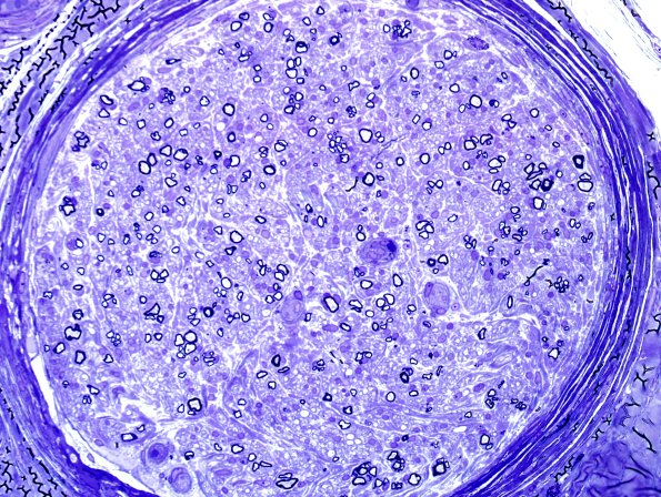 5C1 Axonal Regeneration (Case 6) Plastic 4.jpg