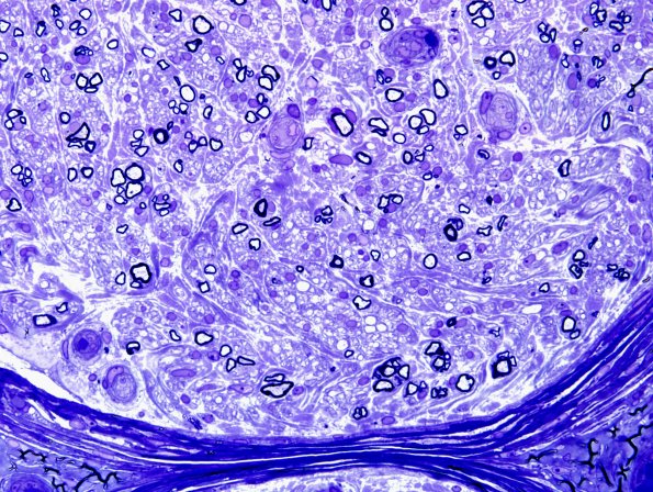 5C2 Axonal Regeneration (Case 6) Plastic 6.jpg