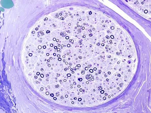 5D1 Regeneration (Case 7) Plastic 1