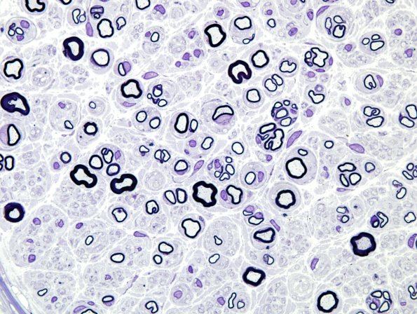 5D2 Regeneration (Case 7) Plastic 3