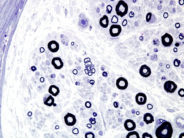 5E Regeneration after degeneration (thin for caliber) (Case 8) Plastic 1