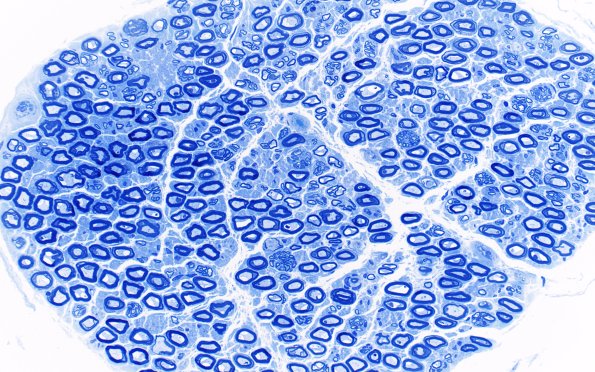 6A1 Regenerative clusters (Case 9) 40X