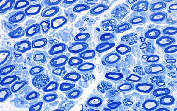 6A2 Regenerative clusters (Case 9) 100X 1