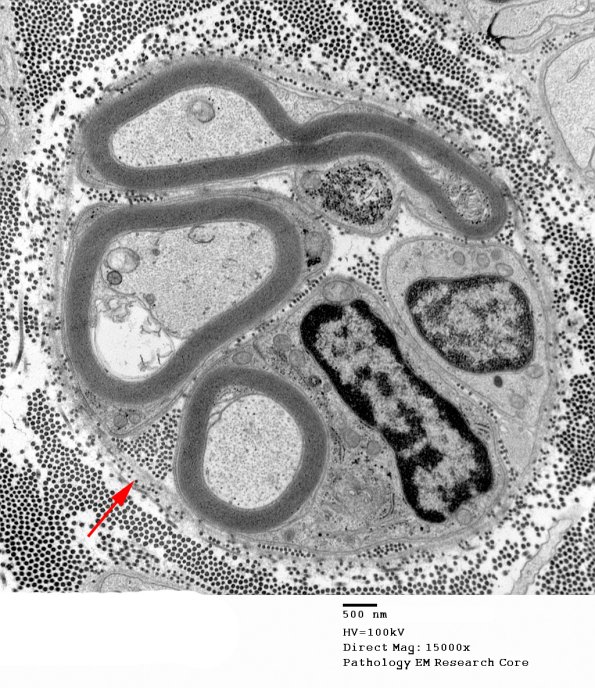 7A1 Axonal Degeneration (Case 10) EM 035 copy - Copy