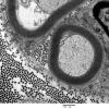 7A2 Axonal Degeneration (Case 10) EM 036 - Copy
