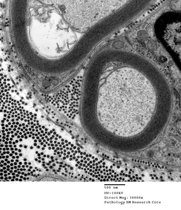 7A2 Axonal Degeneration (Case 10) EM 036 - Copy