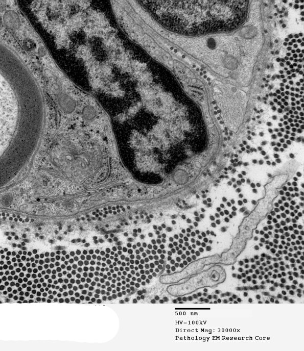 7A4 Axonal Degeneration (Case 10) EM 039 - Copy