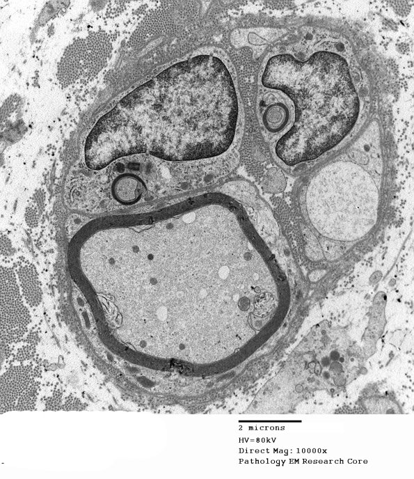 7C Regeneration, axonal clusters (Case 2) 020 - Copy