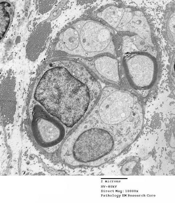 7E Regeneration, axonal clusters (Case 2) 006 - Copy