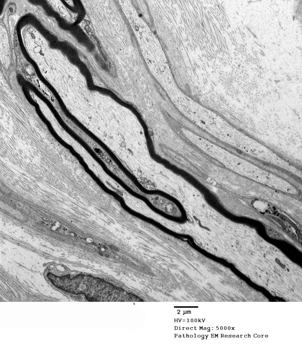 7F Axonal regeneration, longitudinal, axon cluster, Diabetic NP (Case 7) EM 024 - Copy