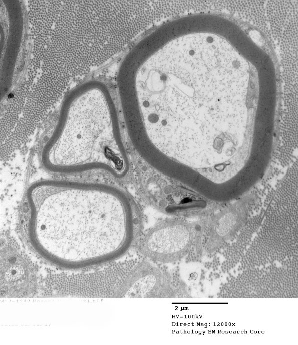 7G1 Axonal Degeneration with Prominent Regeneration (Case 11) EM 023A - Copy