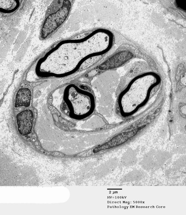 7H1 Axonal Regeneration, Diabetic NP (Case 7) EM 041 - Copy