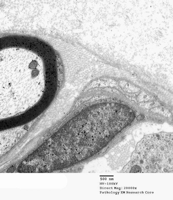 7H2 Axonal Regeneration, Diabetic NP (Case 7) EM 043 - Copy