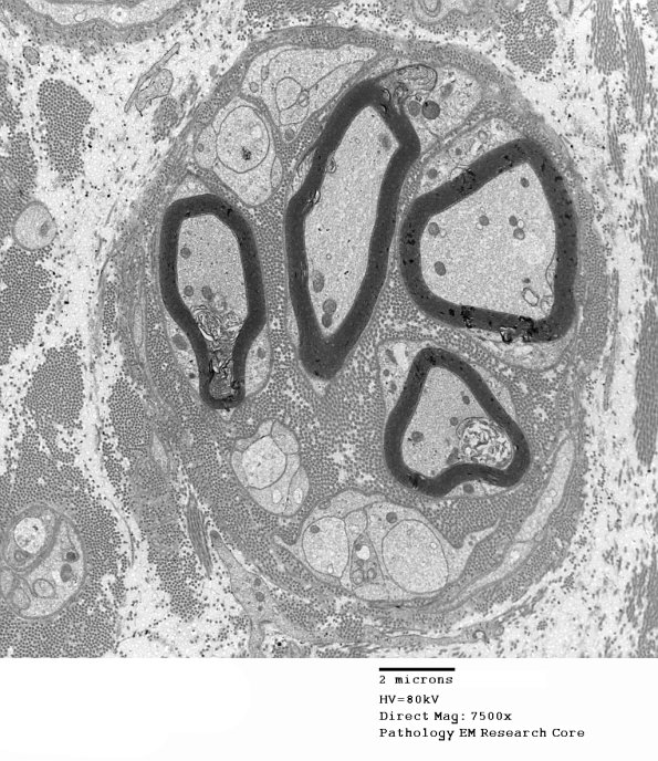 7I Regeneration, axonal clusters (Case 2) 036 - Copy