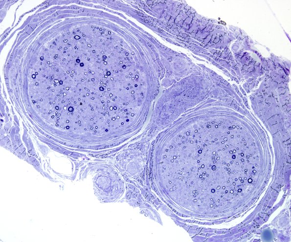 8B1 Axonal degeneration, thin for caliber (Case 13) Plastic 14.jpg