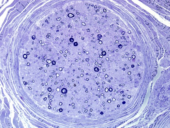 8B2 Axonal degeneration, thin for caliber (Case 13) Plastic 5.jpg