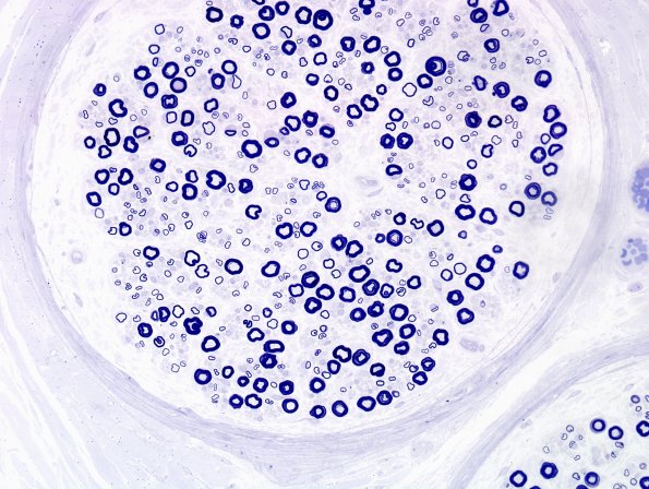 8C1 Axonal Degeneration, thin for caliber (Case 14) Plastic 11.jpg