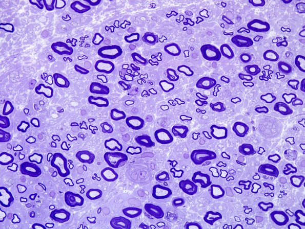 8E Regeneration, artifical increased small MF (Case 15) Plastic 1.jpg