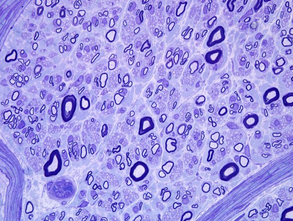 8F Neuropathy (Case 11) Plastic 00X 9.jpg