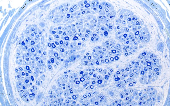 9A1 W25-1606 Bridgers A (Case 16) Sural 40X