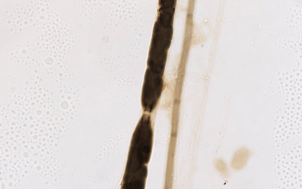 1A2 Demyel teased (Case 1) 100X 3