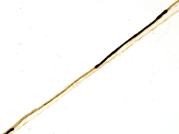 1A4 Demyelination teased (RES)