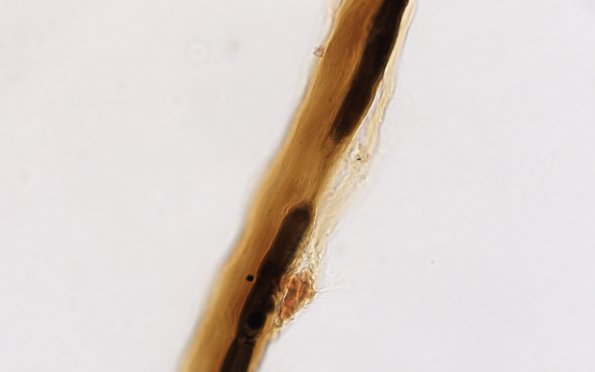 1A5 Demyel teased (Case 1) 100X 1