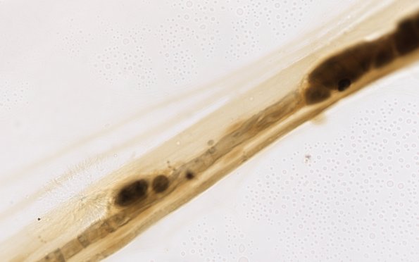 1A6 Demyel teased (Case 1) 100X 2