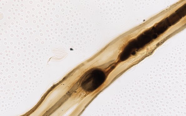 1A7 Demyel teased (Case 1) 100X 4