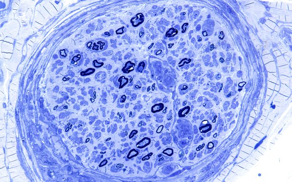 3A1 Dmyel, remyel & AD (Case 3) Plastic 6