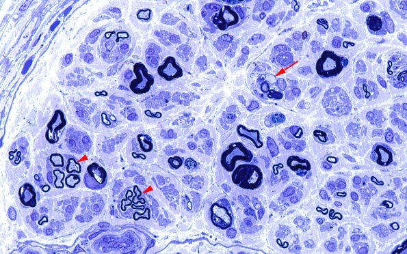 3A2 Dmyel, remyel & AD (Case 3) Plastic 4 copy