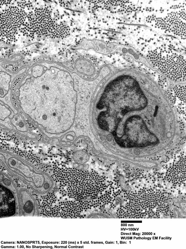 3B1 Dmyel, remyel & AD (Case 3) EM 049 - Copy