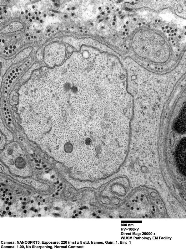 3B2 Dmyel, remyel & AD (Case 3) EM 050 - Copy