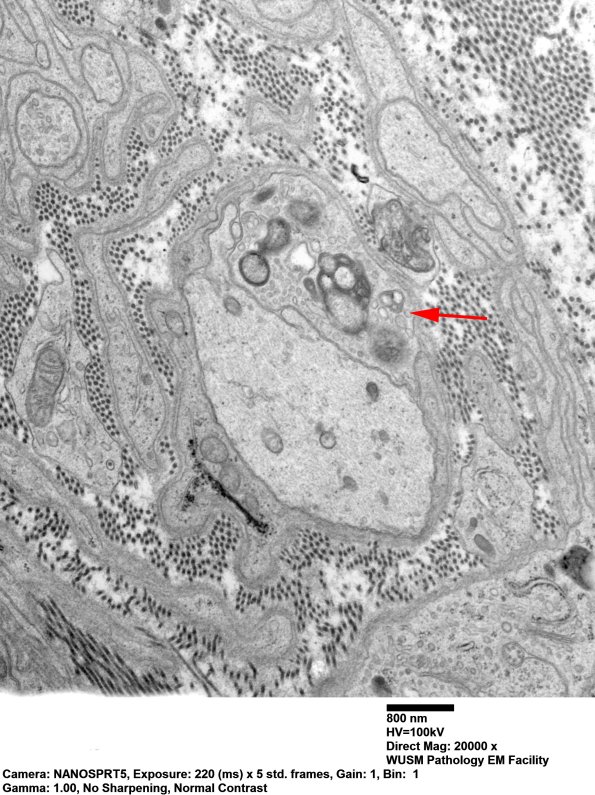 3B3 Dmyel, remyel & AD (Case 3) EM 070 copy - Copy - Copy