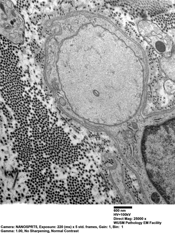 3B4 Dmyel, remyel & AD (Case 3) EM 075 - Copy