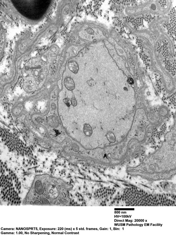 3B5 Dmyel, remyel & AD (Case 3) EM 094 - Copy