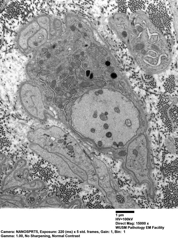 3B6 Dmyel, remyel & AD (Case 3) EM 099 - Copy
