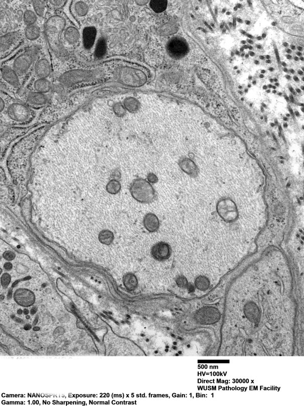 3B7 Dmyel, remyel & AD (Case 3) EM - Copy