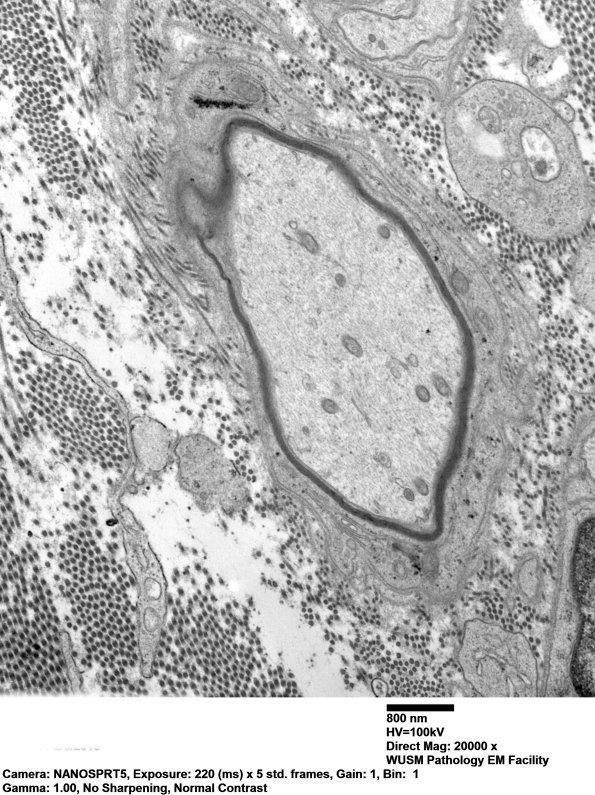 3C2 Remyelination (Case 3) EM 093 - Copy.jpg