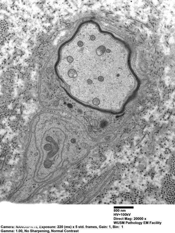 3C3 Remyelination (Case 3) EM 108 - Copy