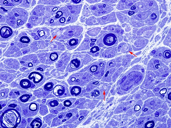 4A2 Demyelination wo remyelination (Case 4) Plastic 7 copy.jpg