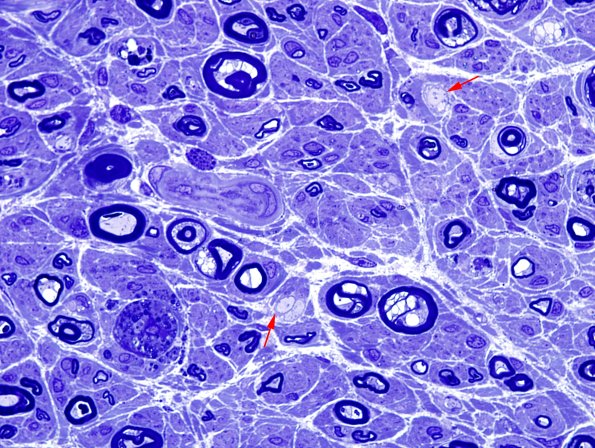 4A3 Demyelination wo remyelination (Case 4) Plastic 11 copy.jpg