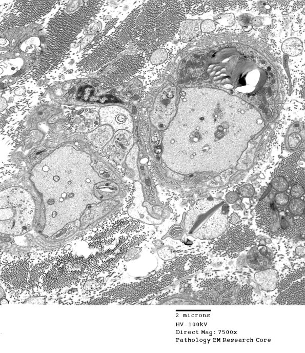 4B1 Demyelination wo remyelination (Case 4) EM 082 - Copy