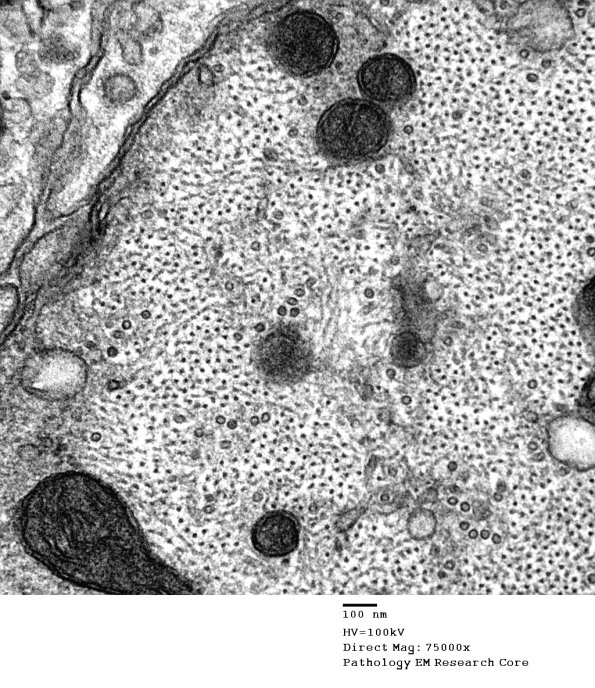 4B10 Demyelination wo remyelination (Case 4) EM 056 - Copy
