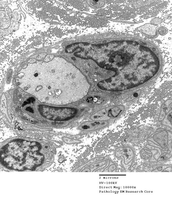 4B11 Demyelination wo remyelination (Case 4) EM 058 - Copy