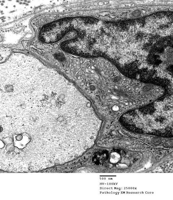 4B12 Demyelination wo remyelination (Case 4) EM 059 - Copy