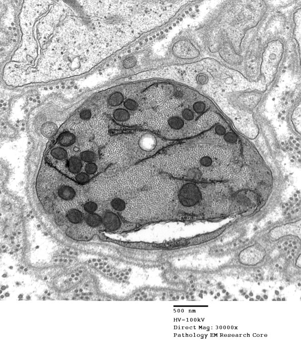 4B13 Demyelination wo remyelination (Case 4) EM 073 - Copy