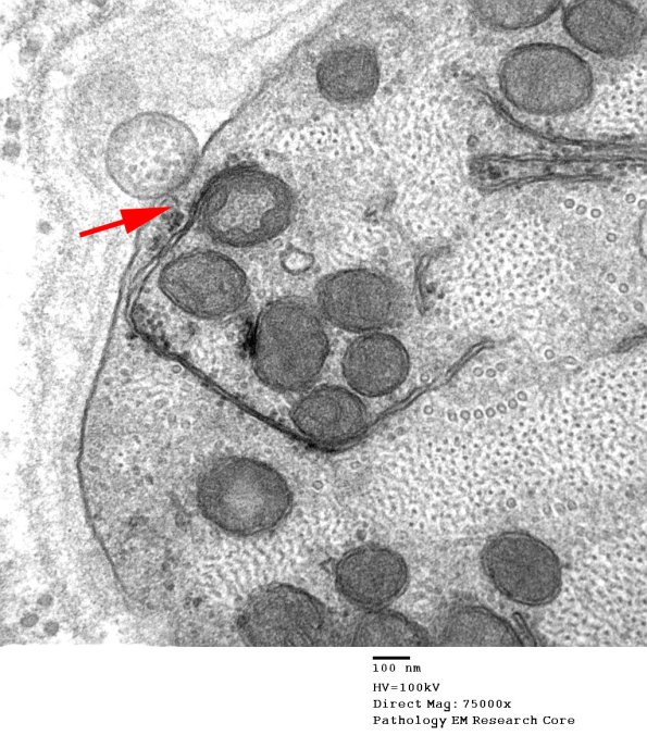 4B14 Demyelination wo remyelination (Case 4) EM 075 copy - Copy