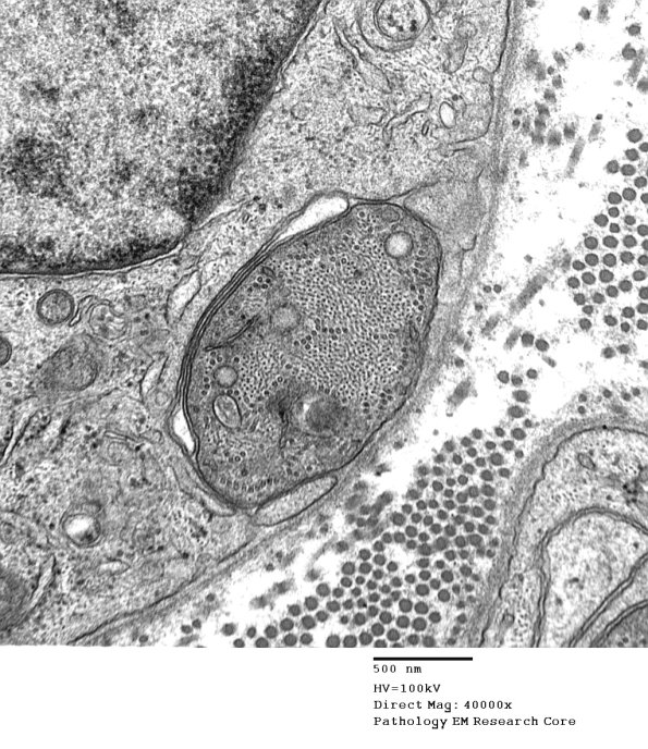 4B16 Demyelination wo remyelination (Case 4) EM 079 - Copy