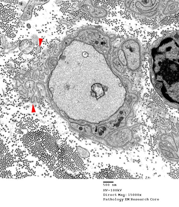 4B2 Demyelination wo remyelination (Case 4) EM 011 copy - Copy
